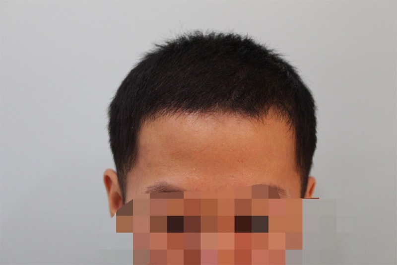 참닥터 비절개 후기 (2).png