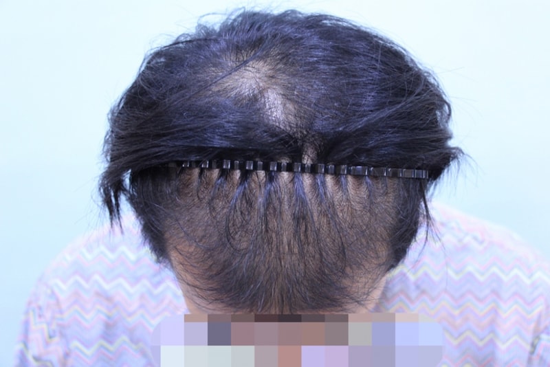 참닥터 비절개 후기 (2).jpg