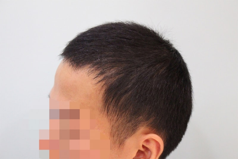 참닥터 비절개 후기 (4).png