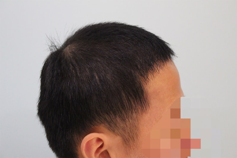 참닥터 비절개 후기 (3).png