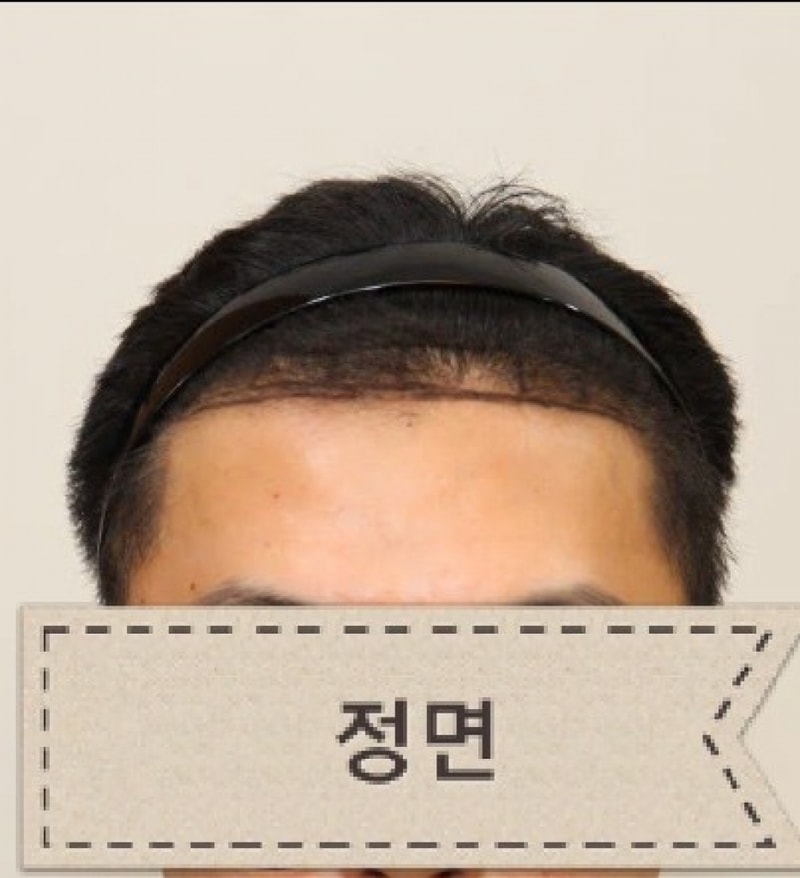 앞머리 및 M자 비절개 모발이식 1200모낭 1주일차 됐습니다.