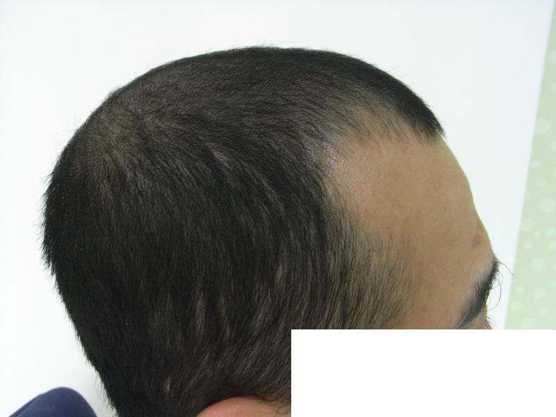 수술전옆.JPG