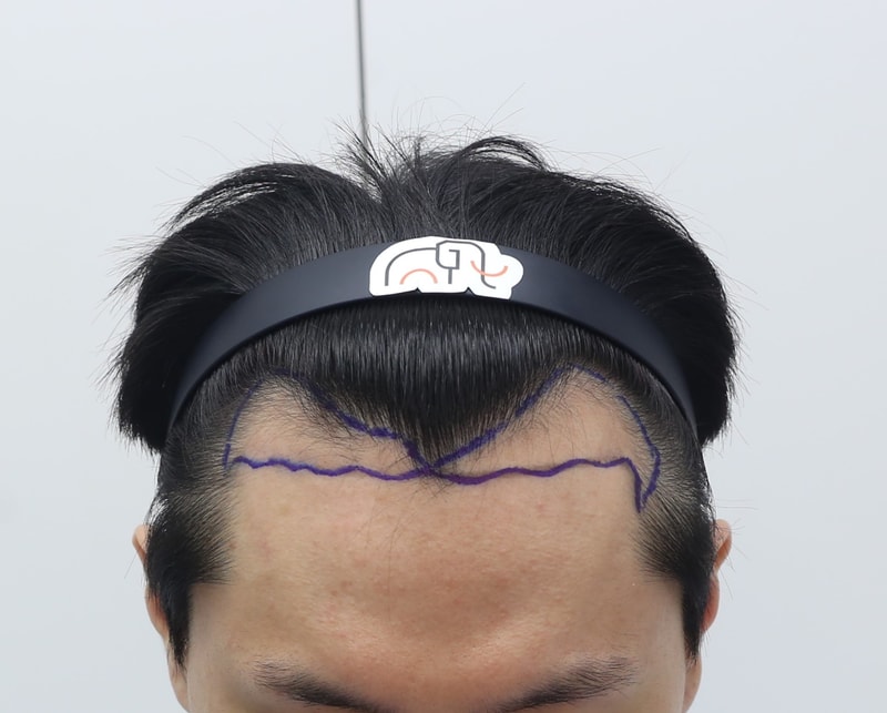 압구정 맘모스헤어라인에서 비절개슬릿 모발이식 4개월 후기입니다.