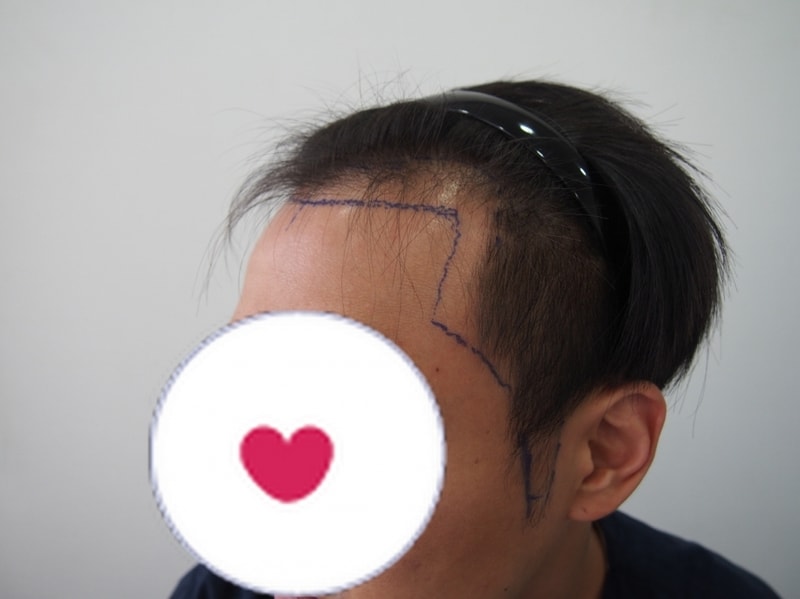 크기변환_수술전좌.JPG