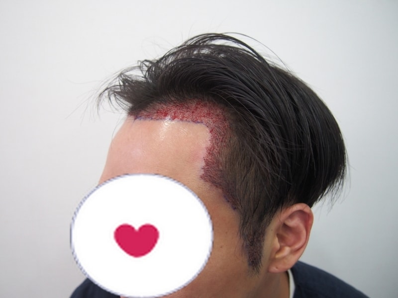 크기변환_수술후좌.JPG