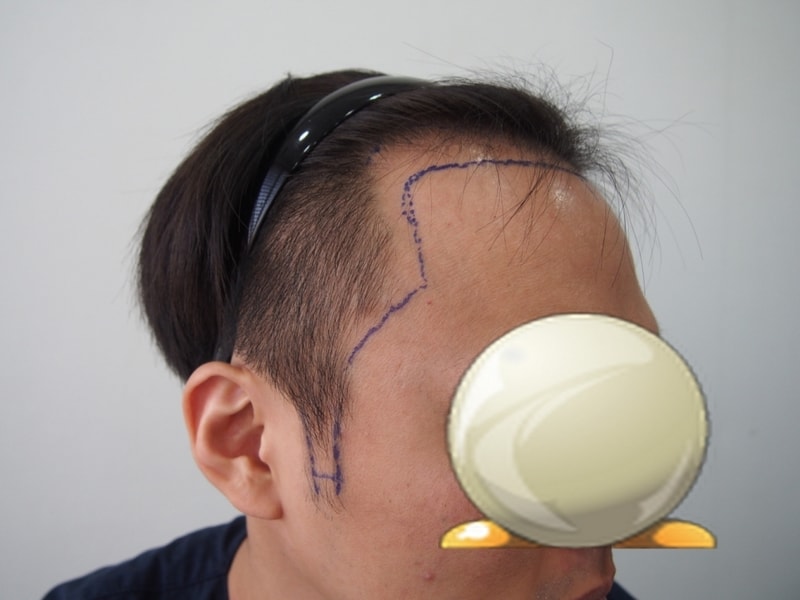 크기변환_수술전우.JPG