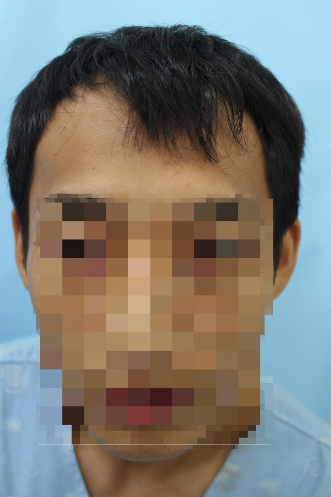 M자 절개 2400모 병원선택부터 수술까지의 자세한 후기
