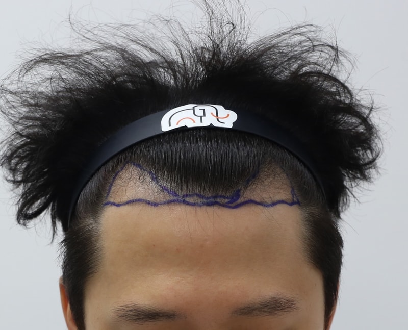 수술 7개월차