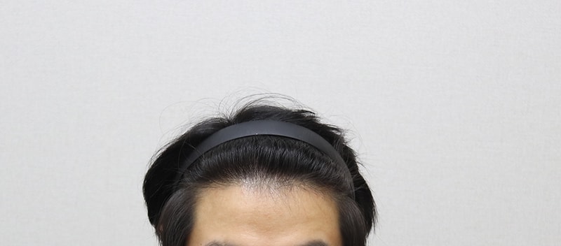6.1년6개월 경과 IMG_0932.JPG