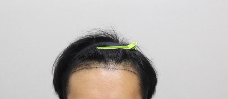 1.수술전 IMG_1026.JPG