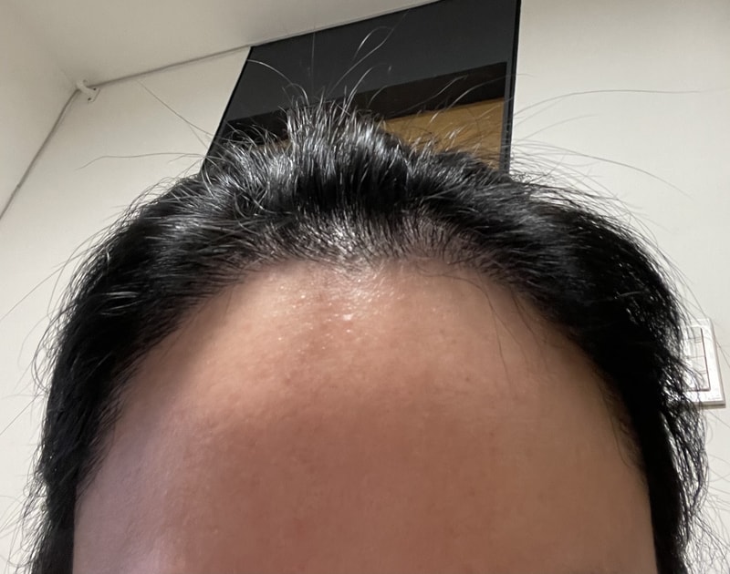 헤어라인이식 6개월 후기 입니다.
