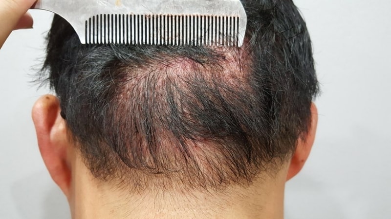 수술후 뒷모낭 비절개.jpeg