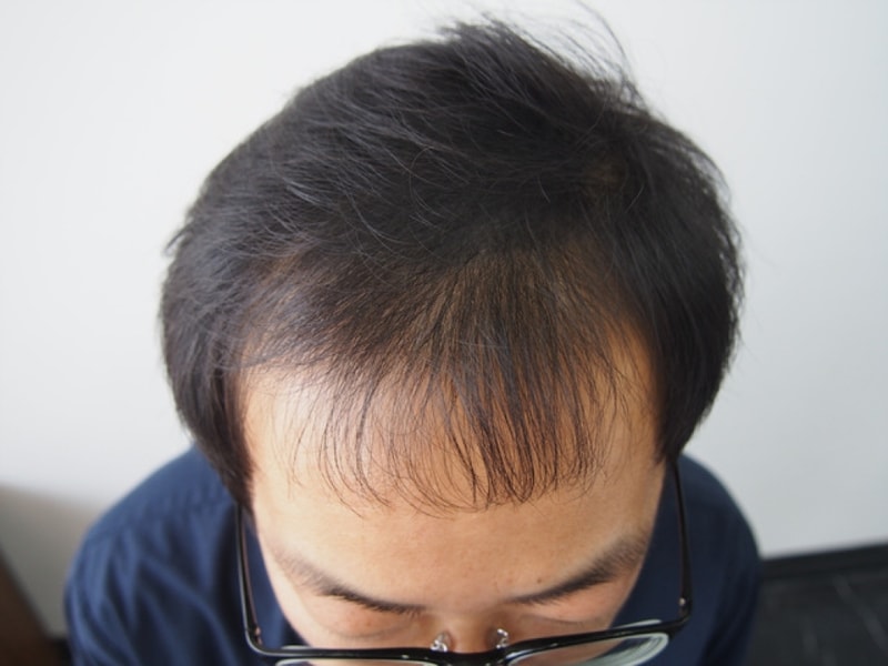 모발이식 전 1.jpg