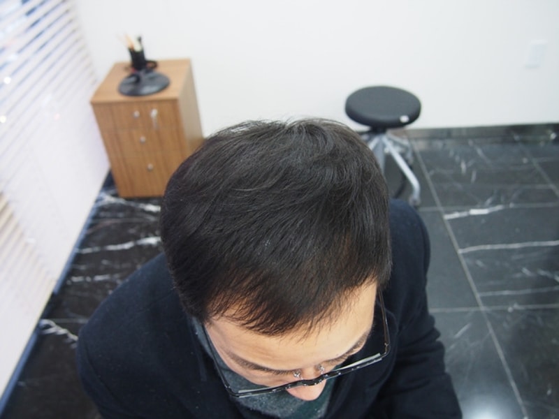 두피문신 시술 후 1달.jpg