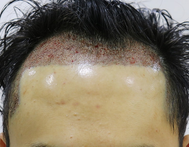 수술 후.JPG