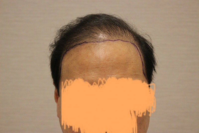 수술전 디자인 (3).JPG