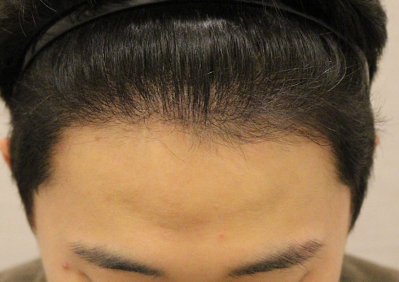 수술후 3개월 (7).JPG