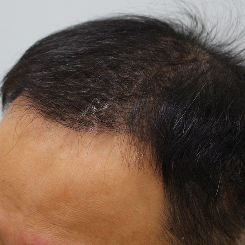 수술후10일 (3).JPG