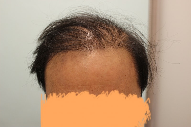 수술후 10일 (6).JPG