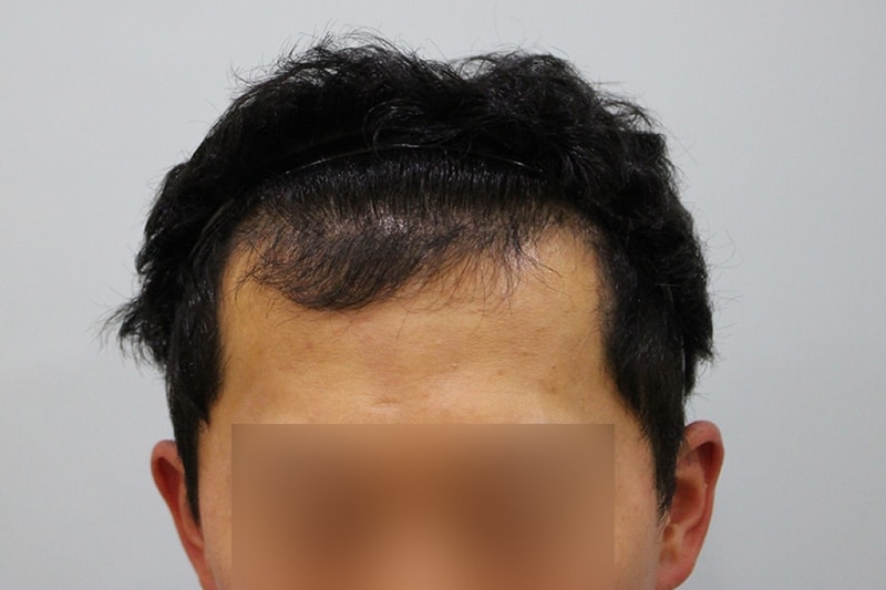 수술후4개월 (2).JPG