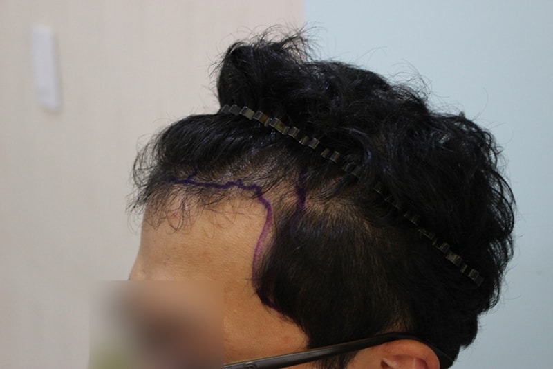 수술전 디자인 (1).JPG