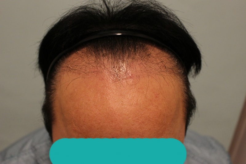 수술후 3개월 (2).JPG