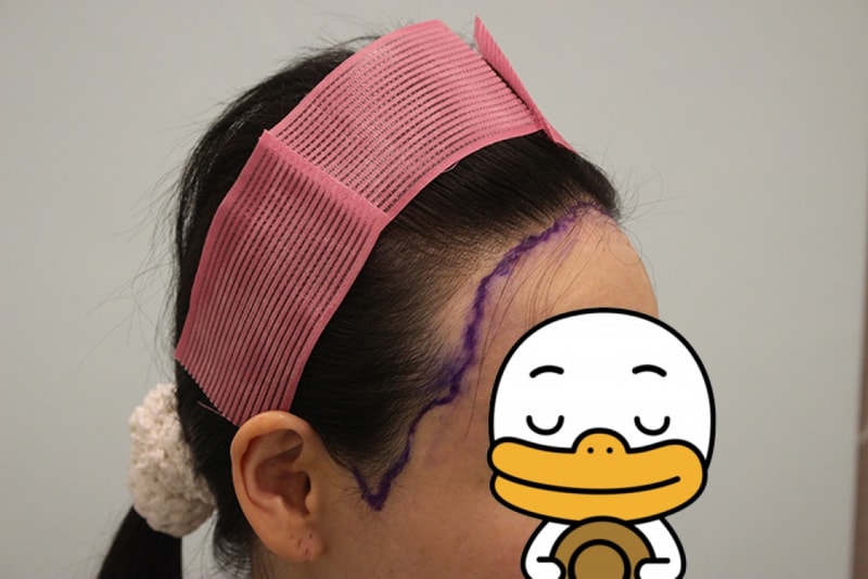 수술전 디자인 (12).JPG