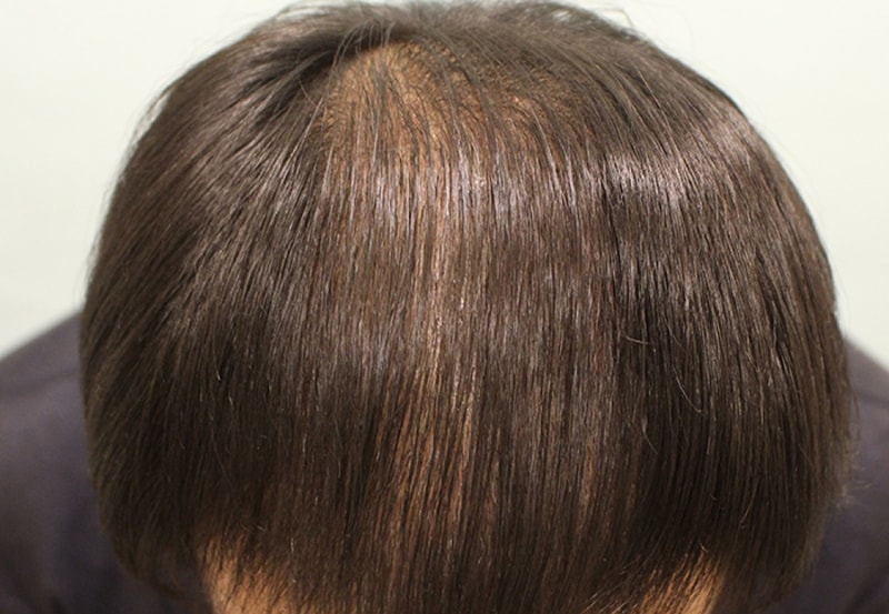 수술후 3개월 (10).JPG