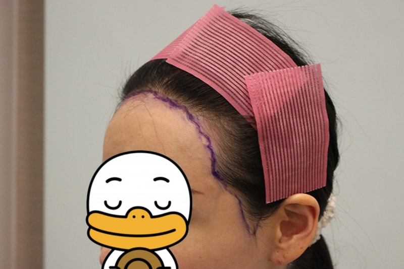 수술전 디자인 (11).JPG