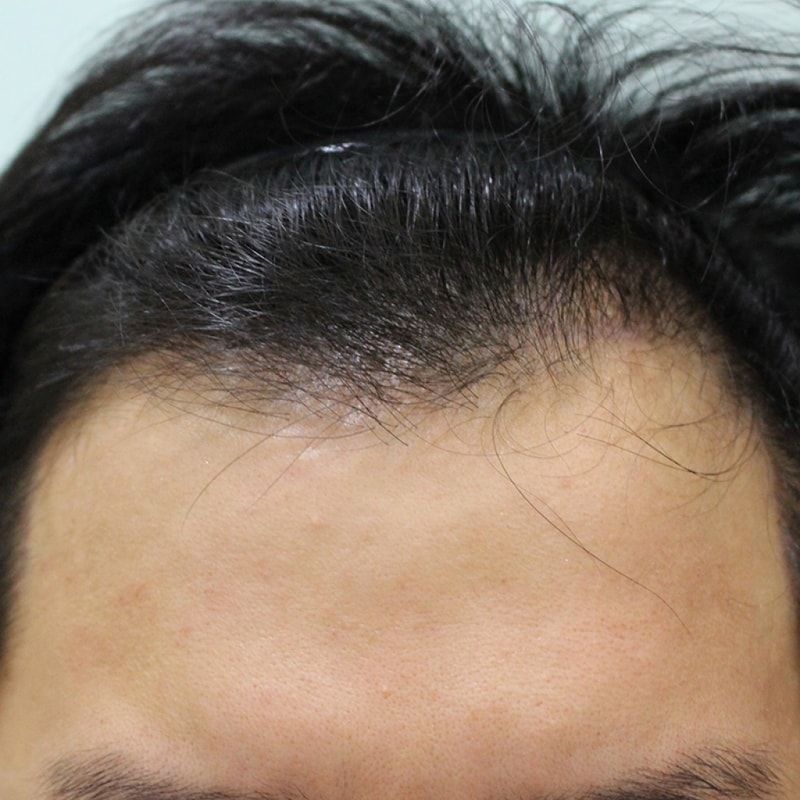 수술후 10일 (13).JPG