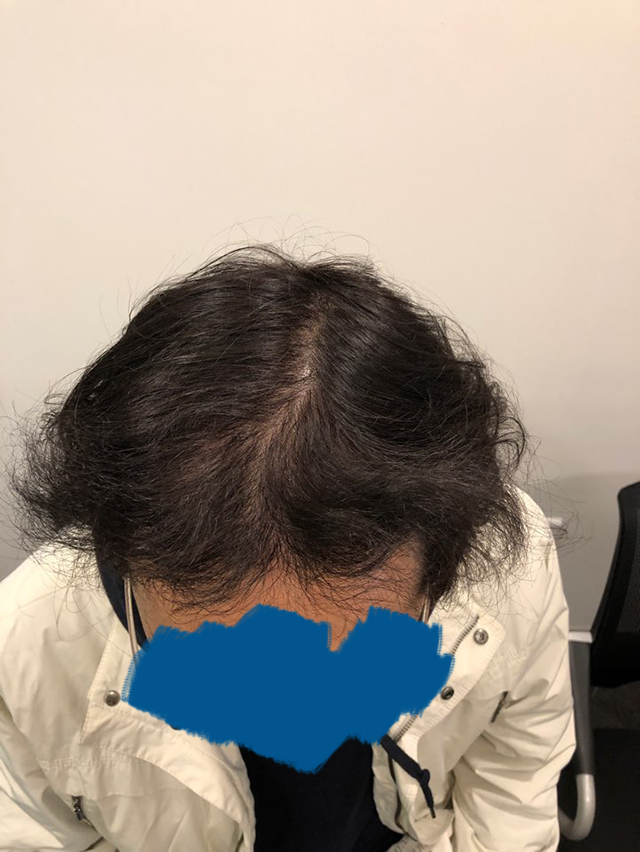 수술후 9개월.jpg