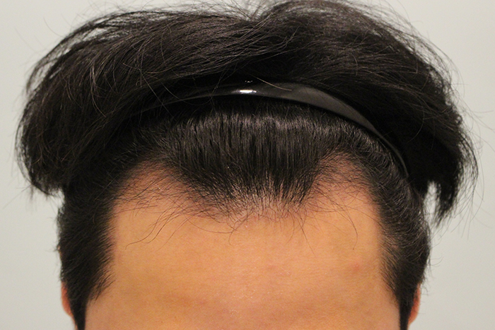 수술후 3개월 (7).JPG