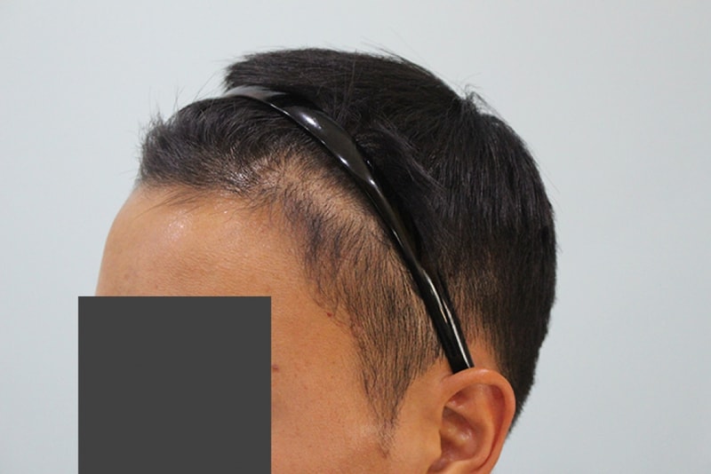 수술후 5개월 (1).JPG