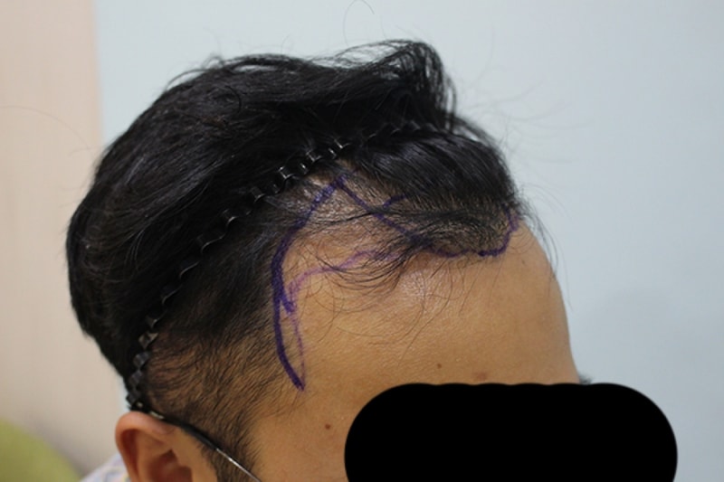 수술전 디자인 (6).JPG