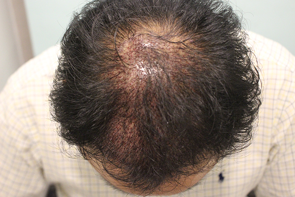 수술후 1일차 (7).JPG