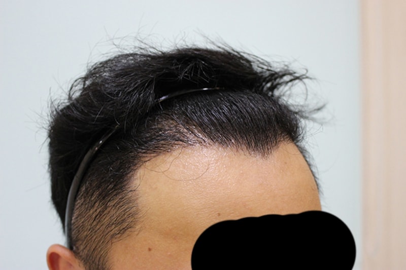 수술후 6개월 (6).JPG