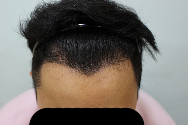 수술후 6개월 (3).JPG