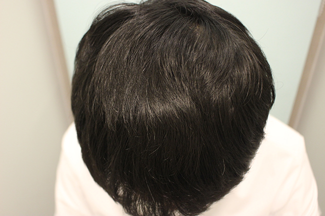 수술후 1년 (1).JPG