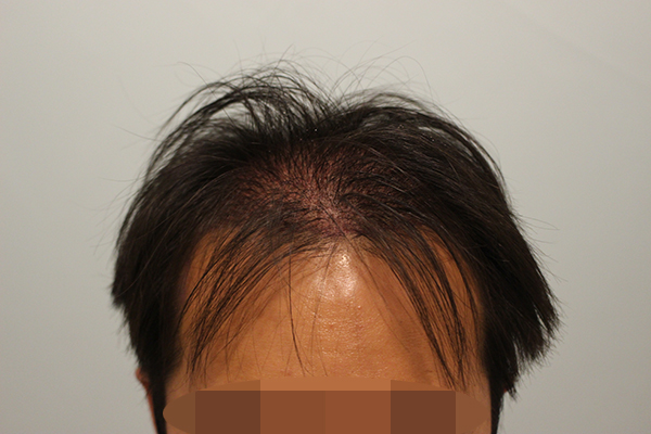 수술후 1일 (1).JPG