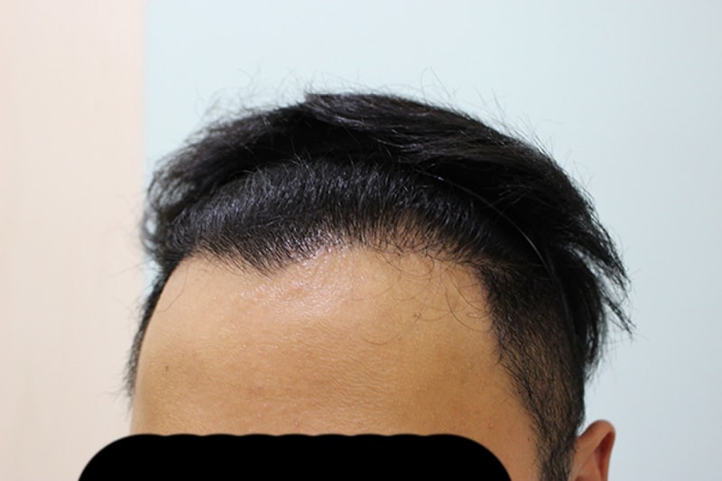 수술후 6개월 (4).JPG