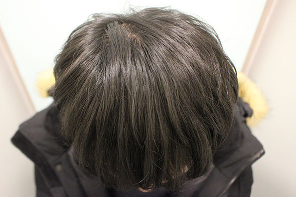 수술후 1년1개월 7.JPG