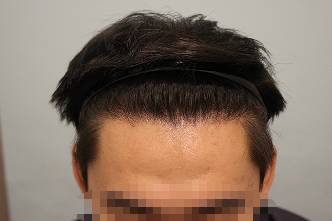 수술후 8개월 (2).JPG