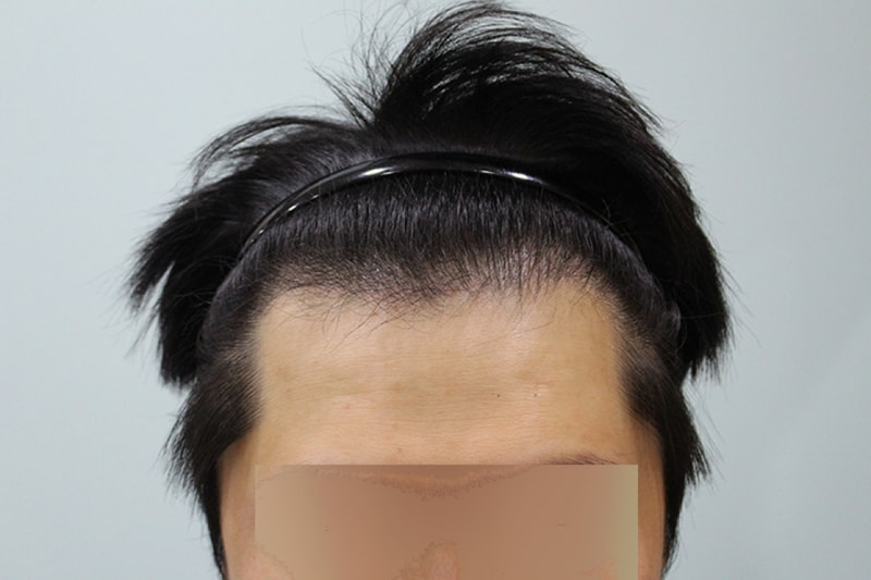 수술후 3개월 (3).JPG
