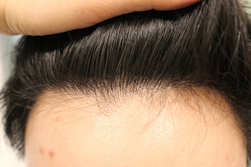 수술후2년 (8).JPG
