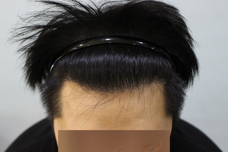 수술후 13개월 (3).JPG