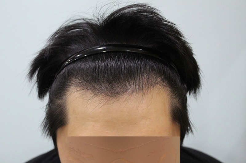 수술후 3개월 (4).JPG