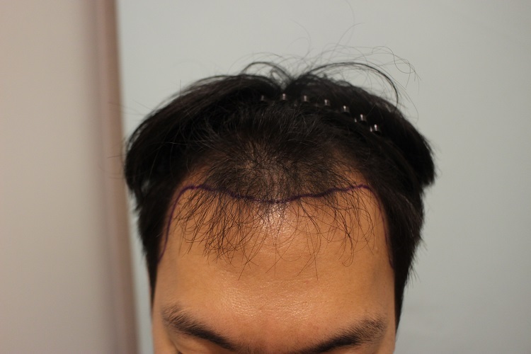수술전 디자인 2.JPG