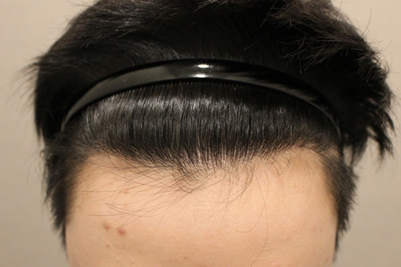 수술후2년 (2).JPG