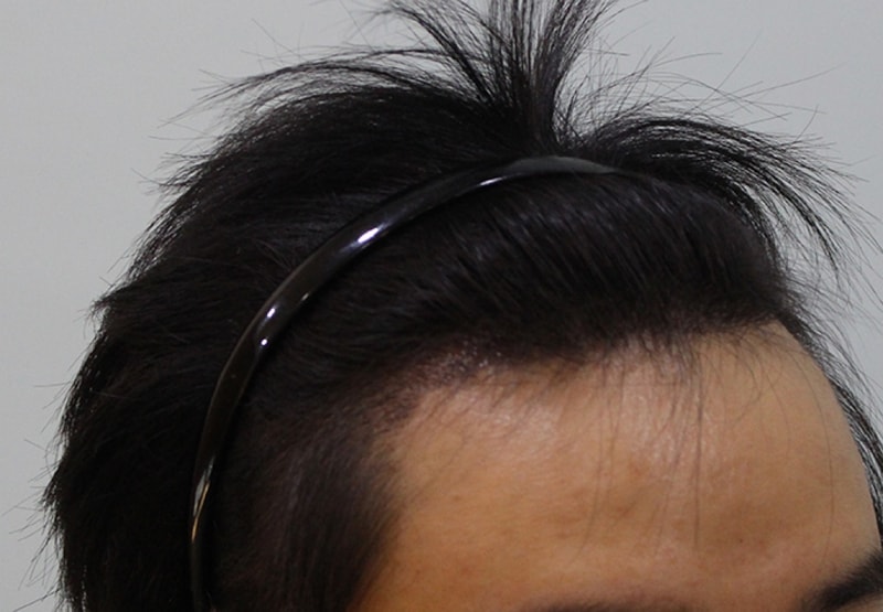 수술후 2주 (2).JPG
