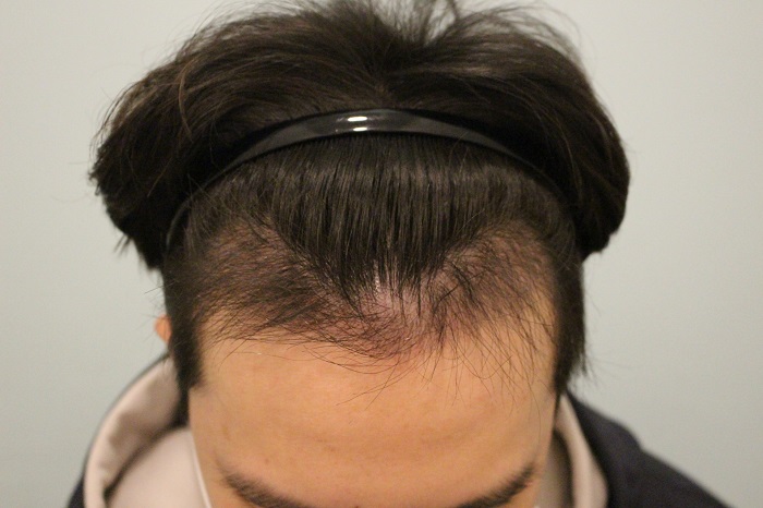 수술후 4개월 2.JPG